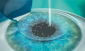 laser eye surgery near me